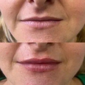 aumento de labios roquetas de mar