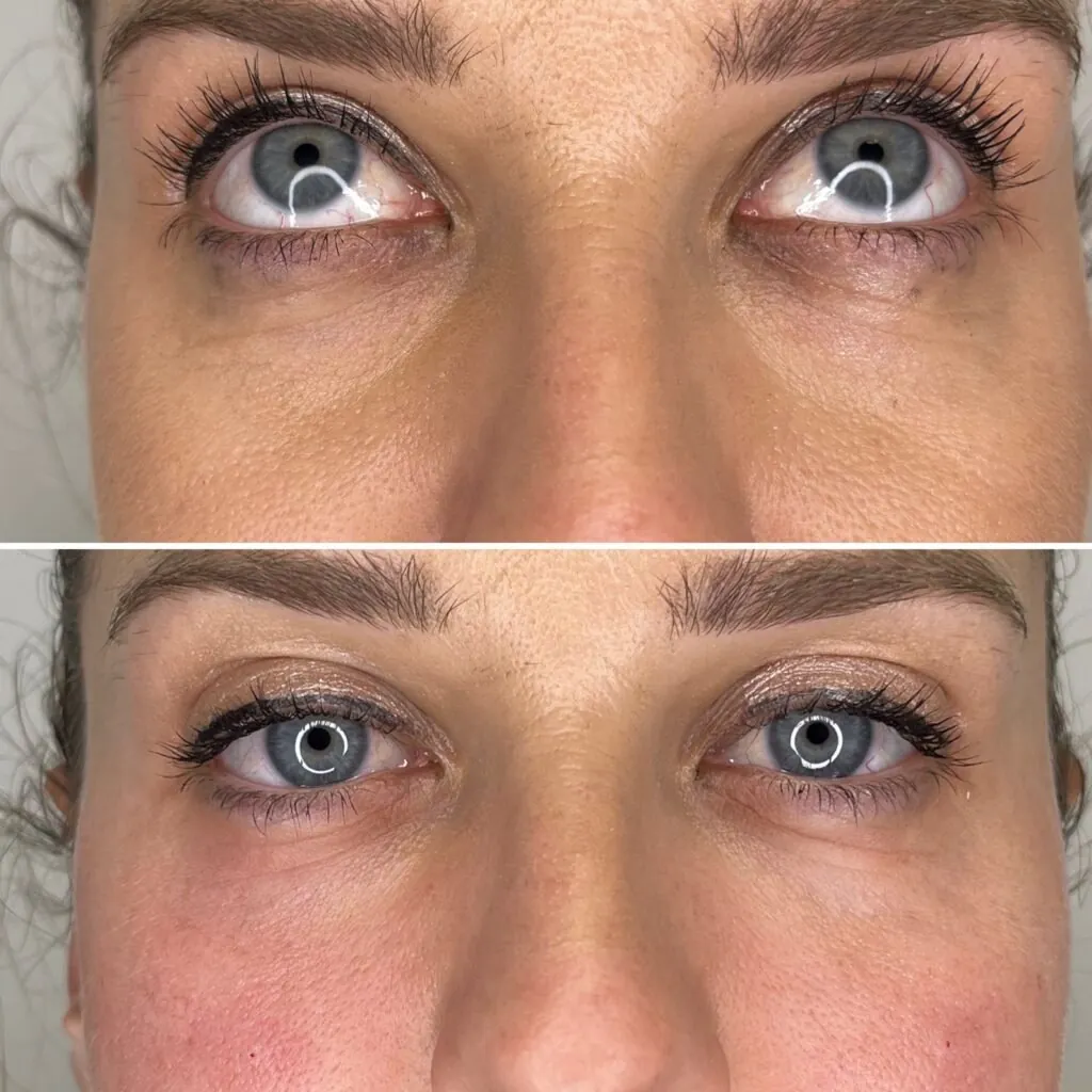 Eliminar ojeras en roquetas de mar