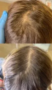 Mesoterapia Capilar