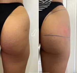remodelación de gluteos en almeria